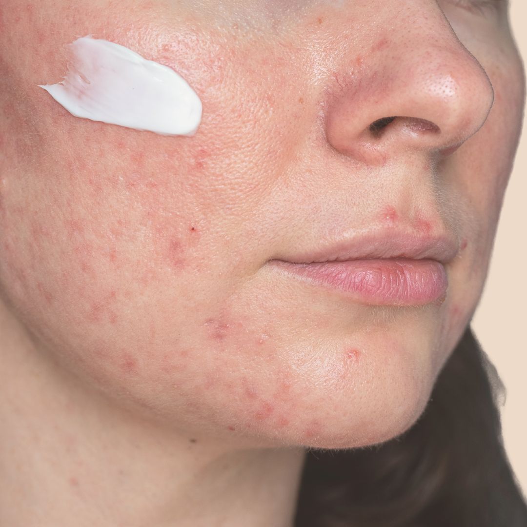 clara ribeiro dermatologia tratamento para acne e rosacea