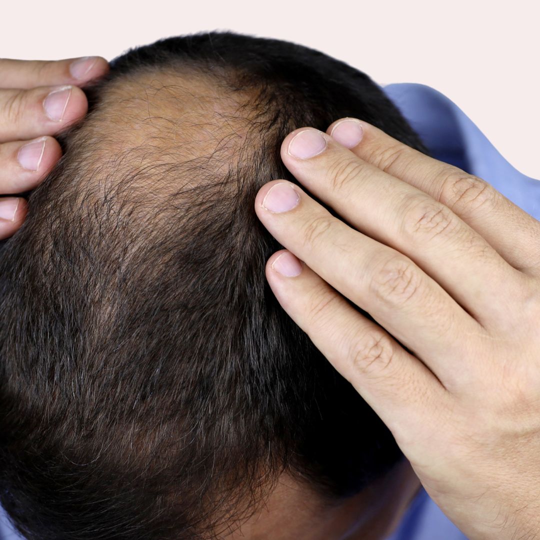 CLARA RIBEIRO TRICOLOGIA DERMATOLOGIA eQueda de Cabelo Masculina — Alopecia Androgenética A calvície masculina tem tratamento. Quanto mais cedo o diagnóstico,