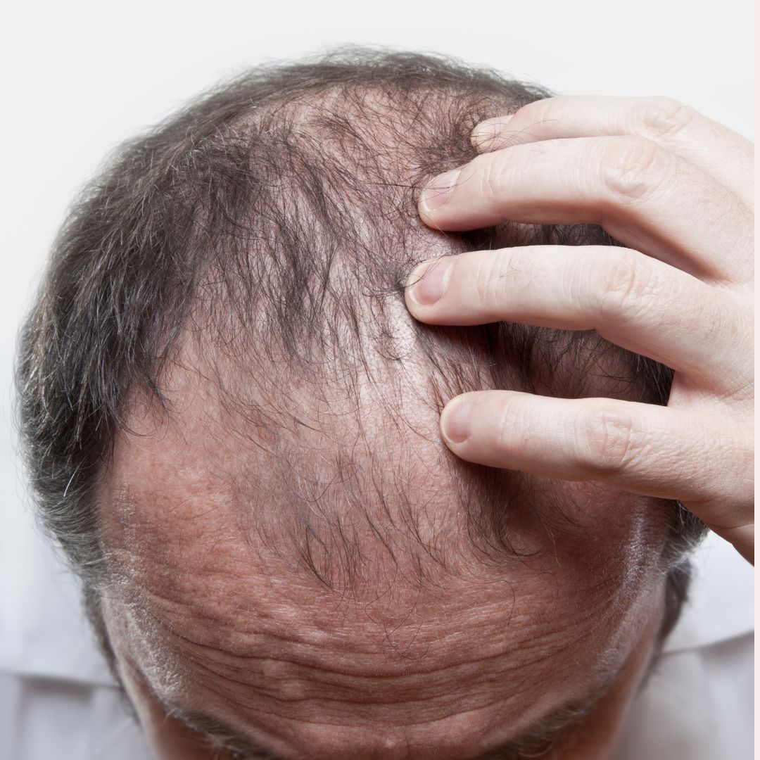 Clara Ribeiro Dermatologia queda de cabelo tricologista Dermatite Seborreica e Saúde do Couro Cabeludo​